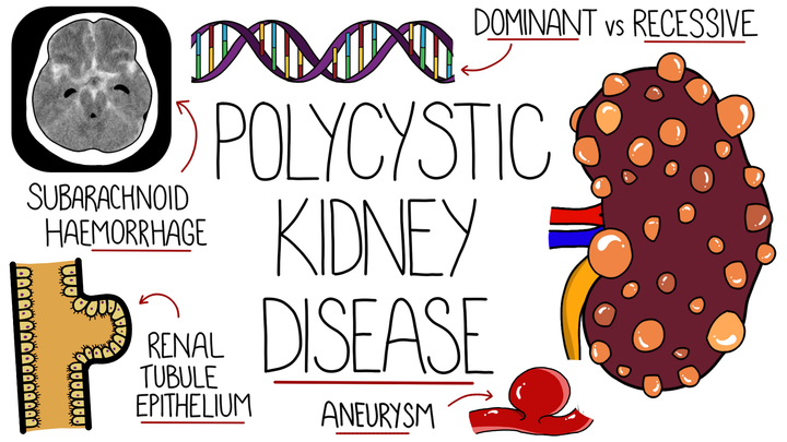 Polycystic Kidney Disease