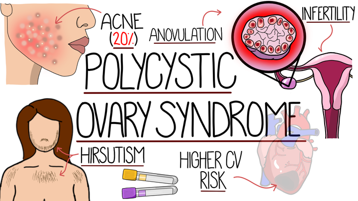 Polycystic Ovary Syndrome (PCOS)