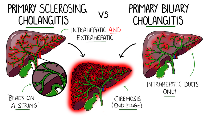 Primary Sclerosing Cholangitis & Primary Biliary Cholangitis