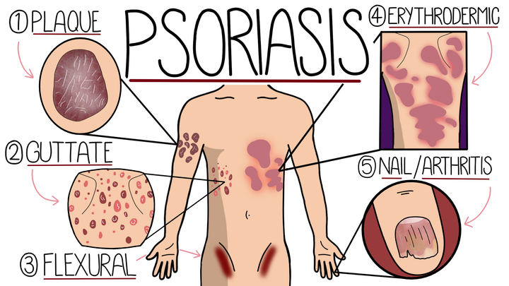 Psoriasis