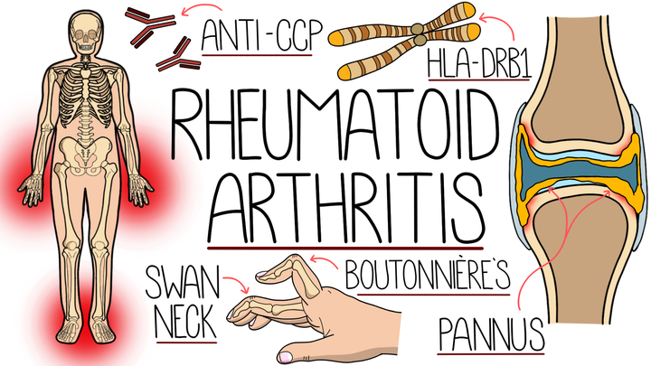 Rheumatoid Arthritis 