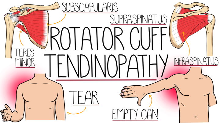 Rotator Cuff Tendinopathy