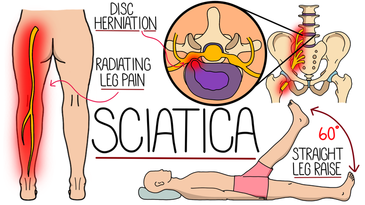 Sciatica