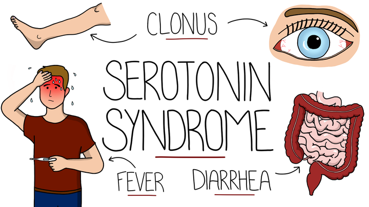 Serotonin Syndrome