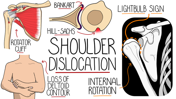 Shoulder Dislocation