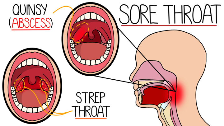 Acute Sore Throat and Causes