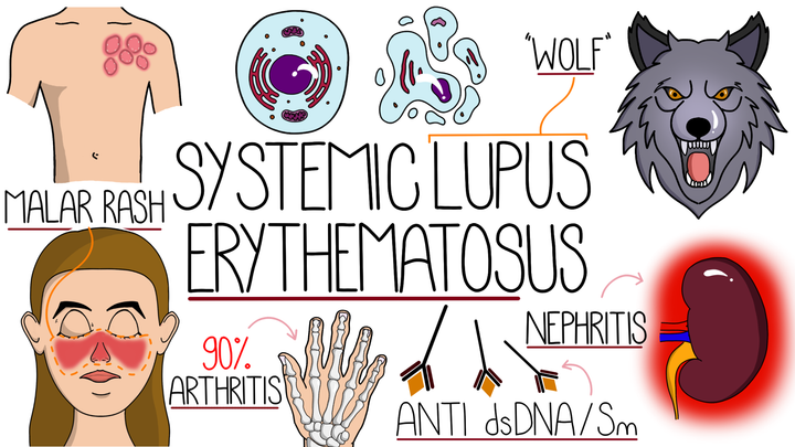 Systemic Lupus Erythematosus