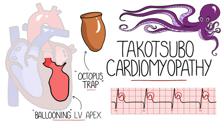 Takotsubo Cardiomyopathy