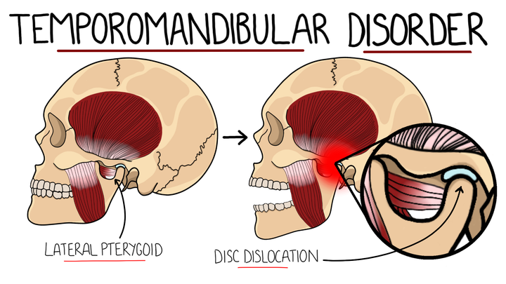 Temporomandibular Joint Disorder (TMJ Disorder)
