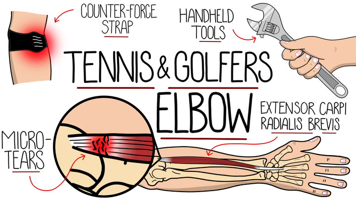 Tennis Elbow and Golfers Elbow