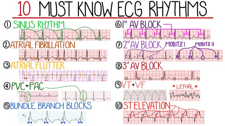 Common ECG Abnormalities and Patterns