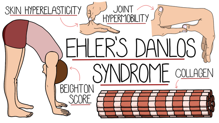 Ehlers-Danlos Syndrome