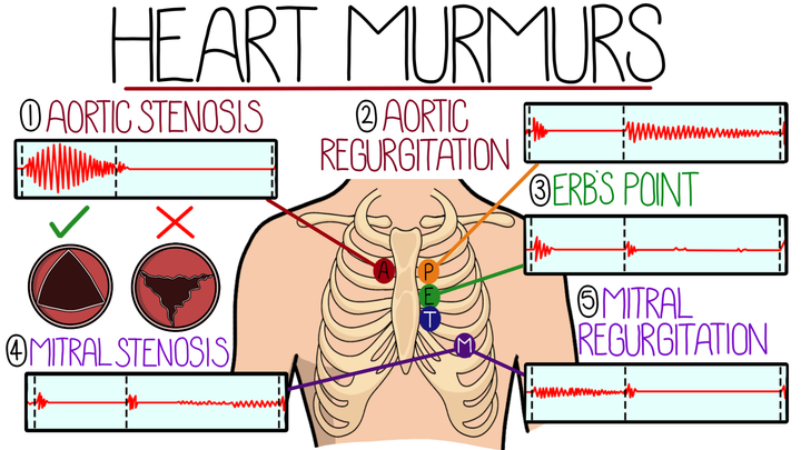 Heart Murmurs Made Easy