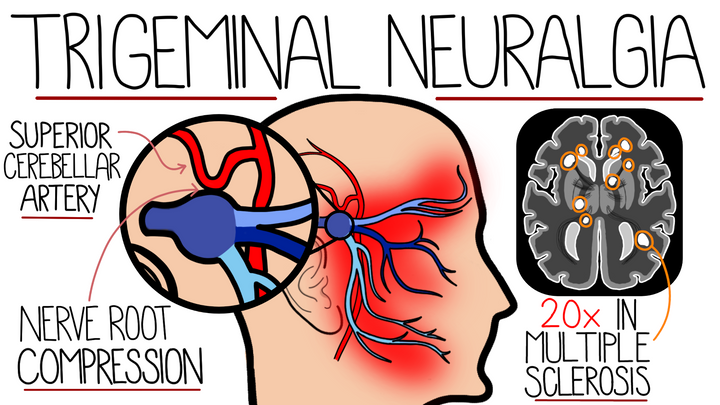 Trigeminal Neuralgia