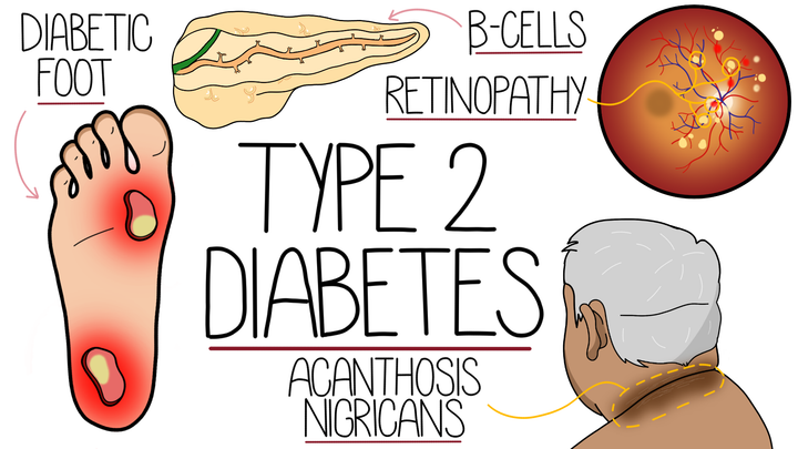 Type 2 Diabetes Millitus