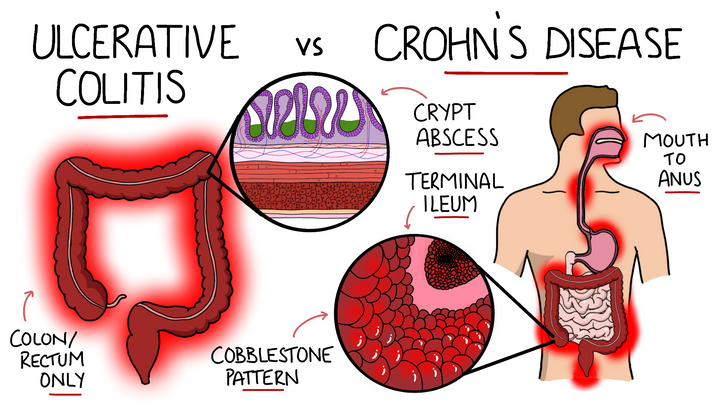 Ulcerative Colitis vs Chron's Disease