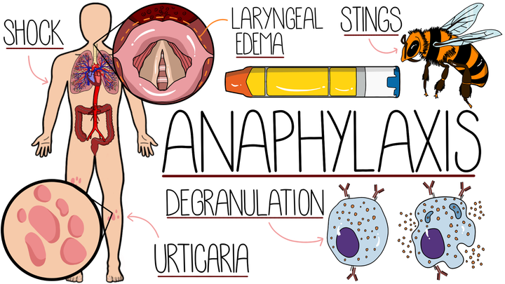Anaphylaxis 
