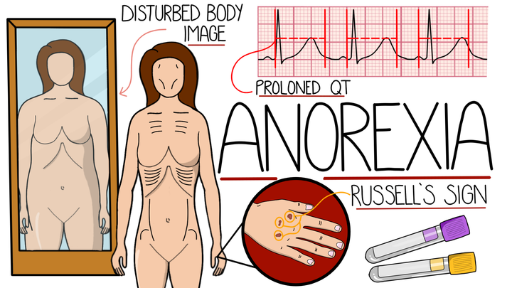 Anorexia Nervosa