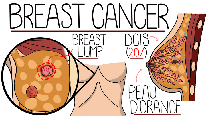 Breast Cancer