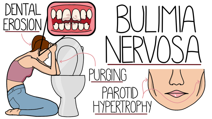 Bulimia Nervosa