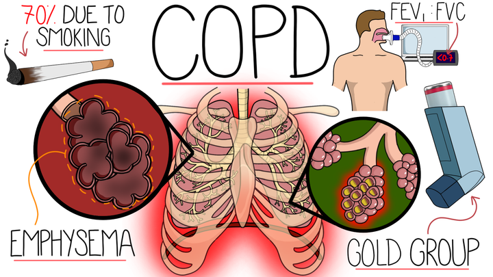 Chronic Obstructive Pulmonary Disease (COPD)