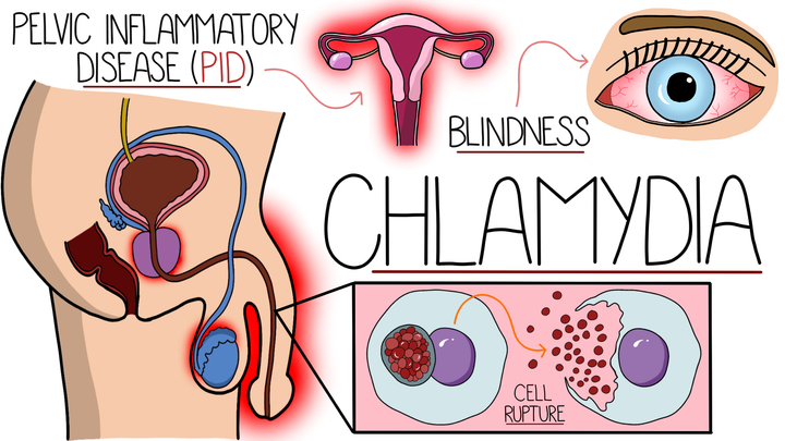 Chlamydia