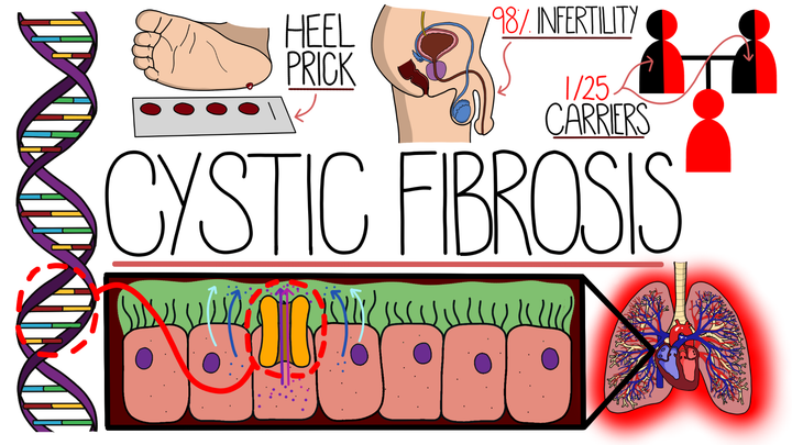 Cystic Fibrosis