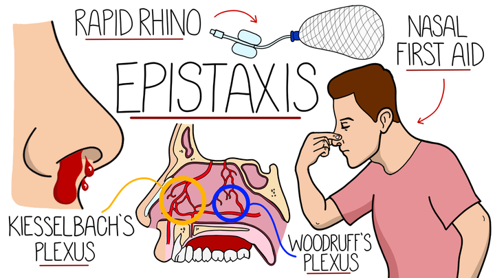 Epistaxis