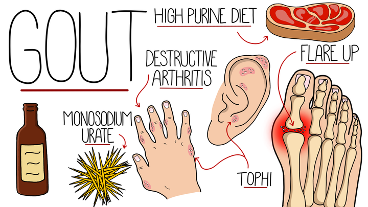Gout