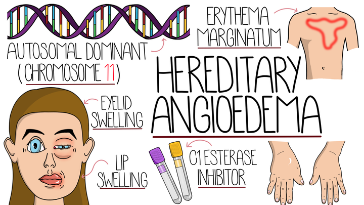 Hereditary Angioedema 