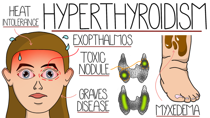 Hyperthyroidism