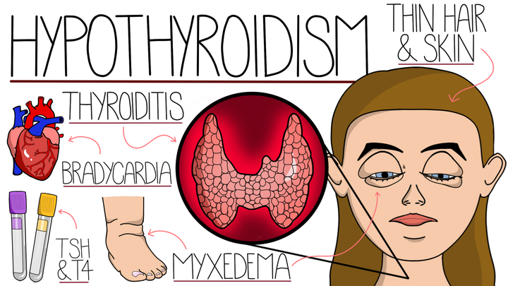 Hypothyroidism