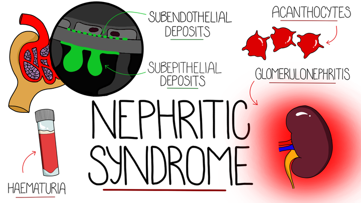 Nephritic Syndrome