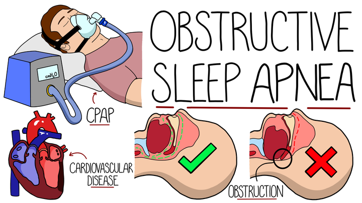 Obstructive Sleep Apnea