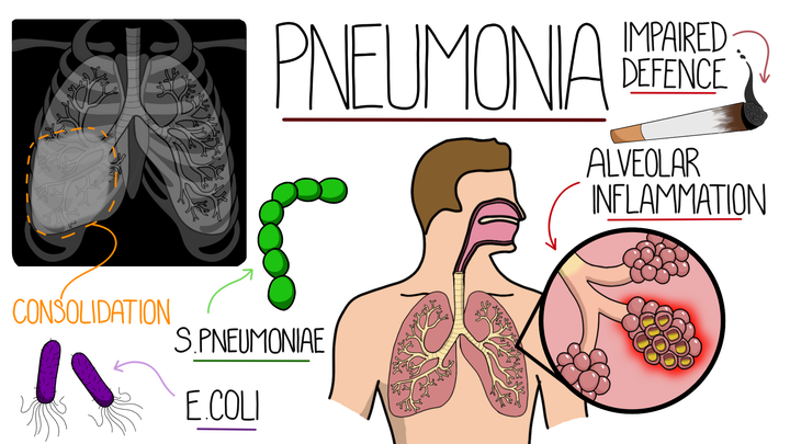 Pneumonia