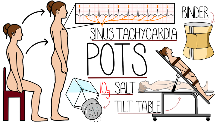 Postural Orthostatic Tachycardia Syndrome (POTS)
