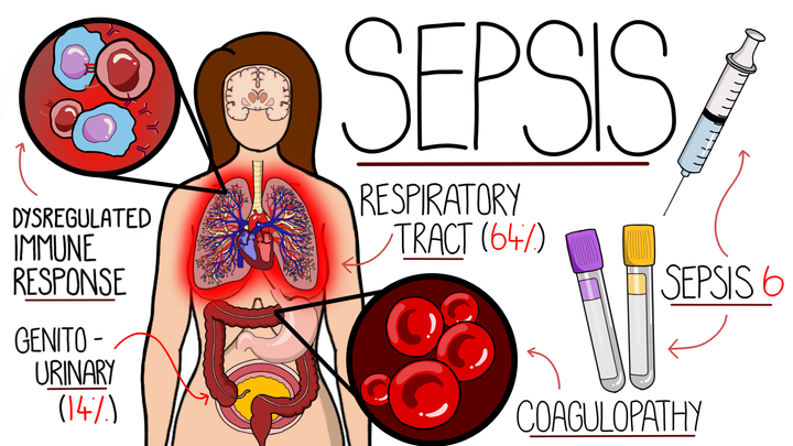 Sepsis