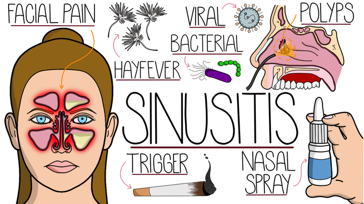 Sinusitis
