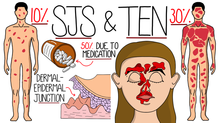 Stevens-Johnson Syndrome & TEN