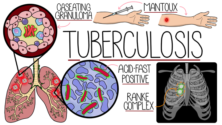 Tuberculosis