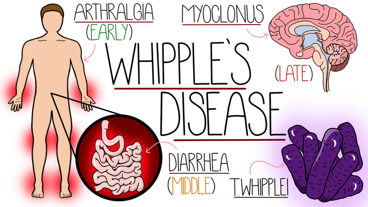 Whipple's Disease