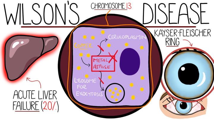 Wilson's Disease