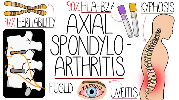 Axial Spondyloarthritis 