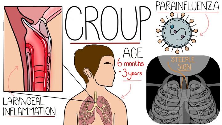 Croup