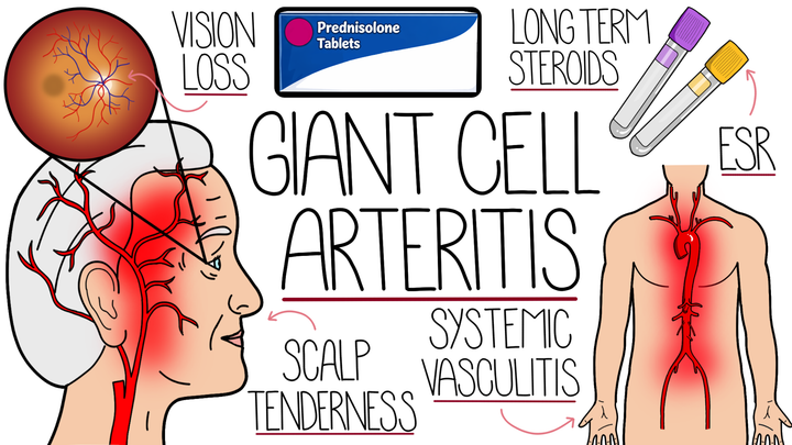 Giant Cell Arteritis 