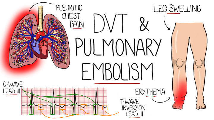 Venous Thromboembolism
