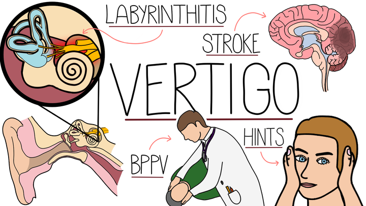 An Appproach to Vertigo